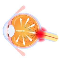 An illustration of the stress imposed by the intraocular pressure on the ocular structure